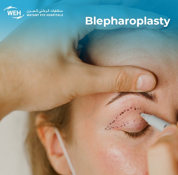 Blepharoplasty and its Types