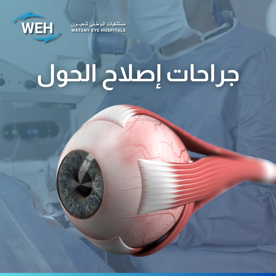 عملية تصحيح الحول