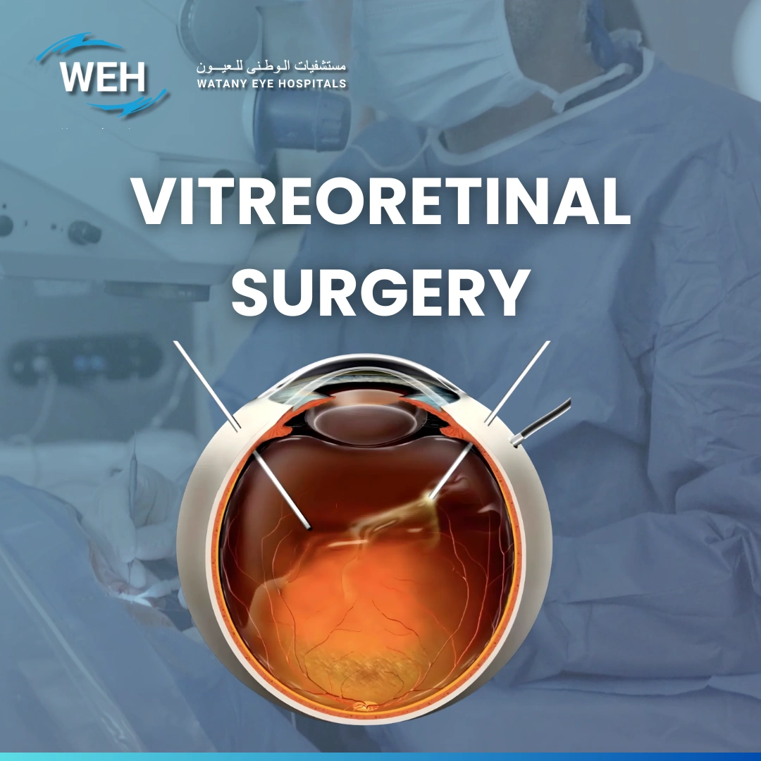 Vitrectomy Surgery