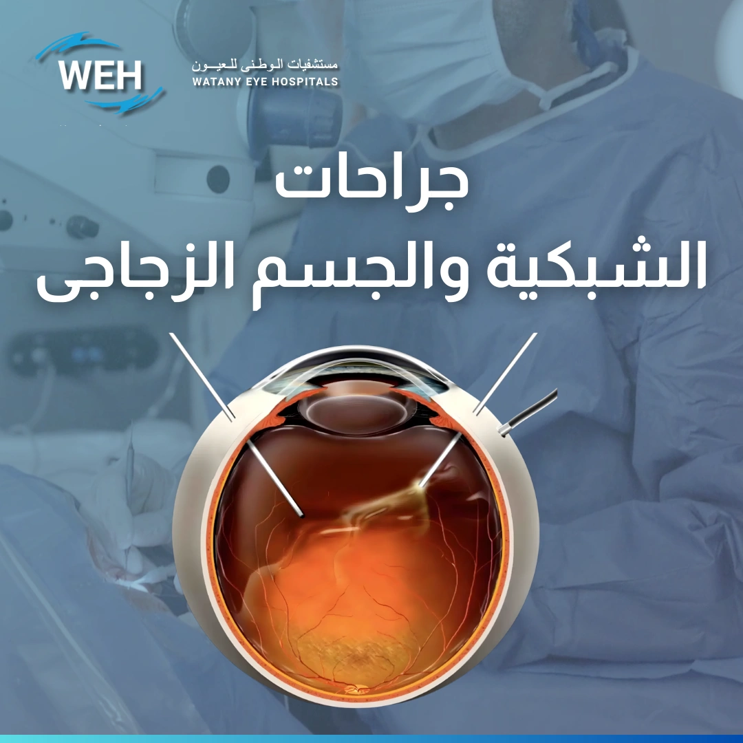 عملية استئصال الجسم الزجاجي