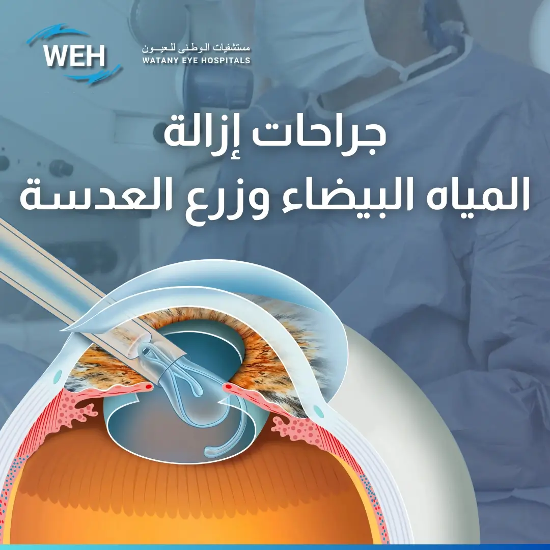 عملية المياة البيضاء